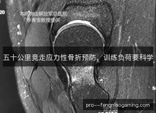 五十公里竞走应力性骨折预防,训练负荷要科学 五十公里竞走应力性骨折预防,训练负荷要科学
